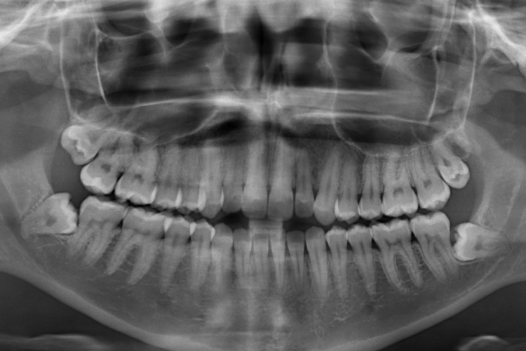Panoramic X-ray of patient with 4 wisdom teeth that need to be removed