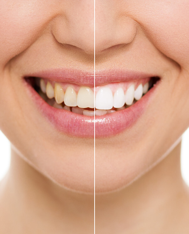 Before and After Professional Teeth Whitening