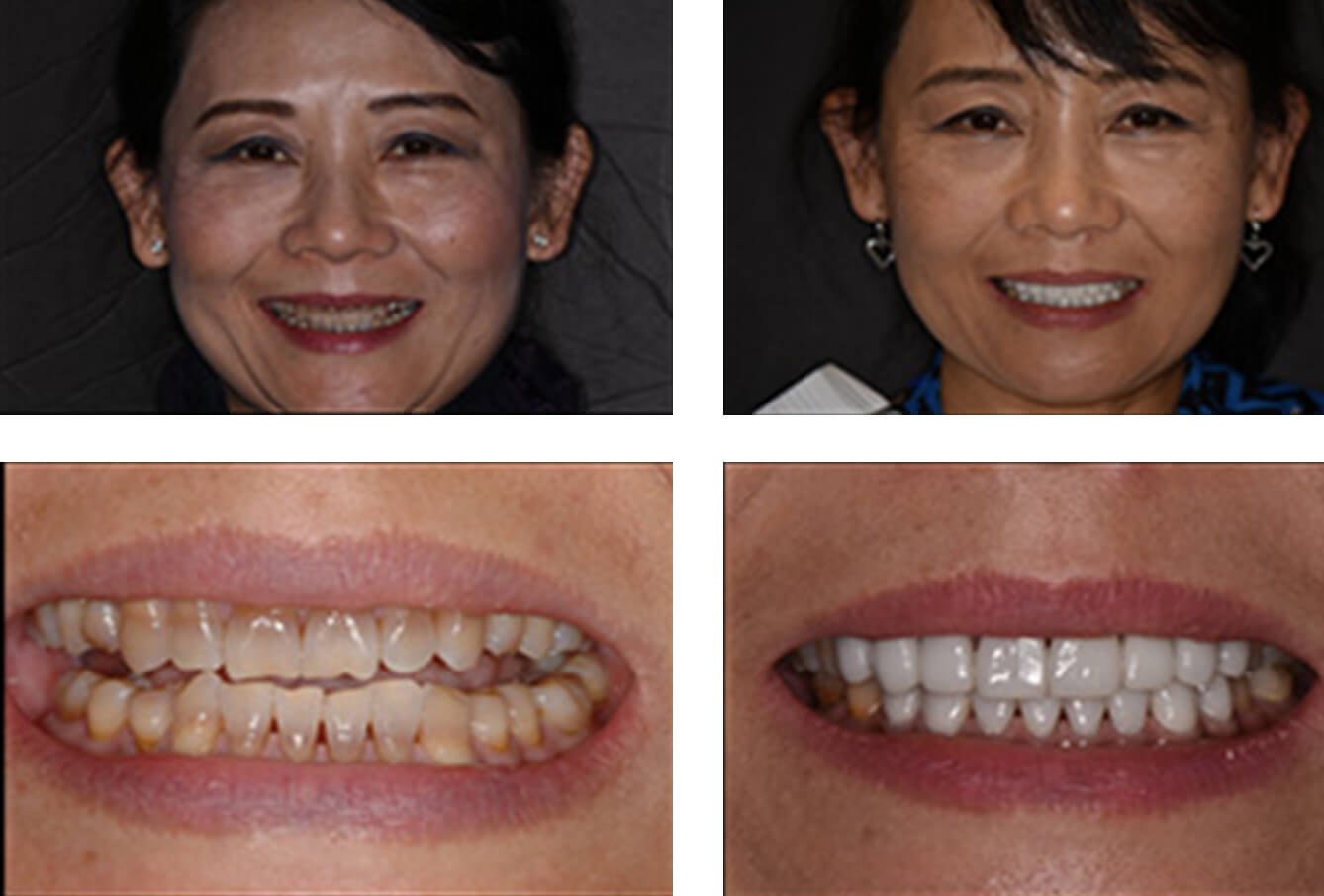 Smile transformation collage