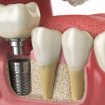 Closeup of a dental implant post topped with a dental crown