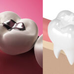 Silver filling/dental amalgam filling vs a tooth-colored filling/composite filling
