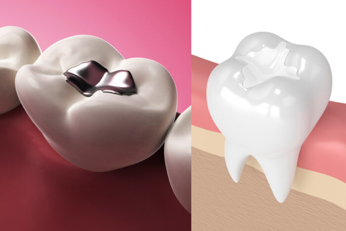 Silver Filling vs Composite Filling - Optima Dental Spa