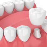 Closeup of a same-day CEREC dental crown from Optima Dental Spa