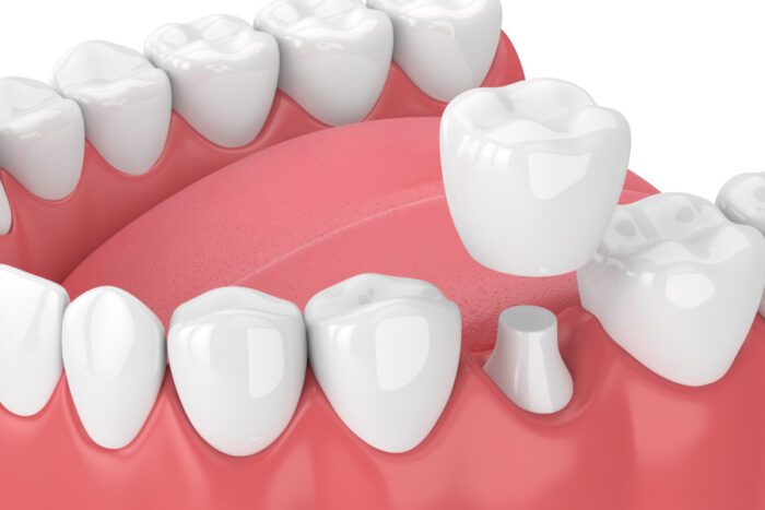 Closeup of a same-day CEREC dental crown from Optima Dental Spa